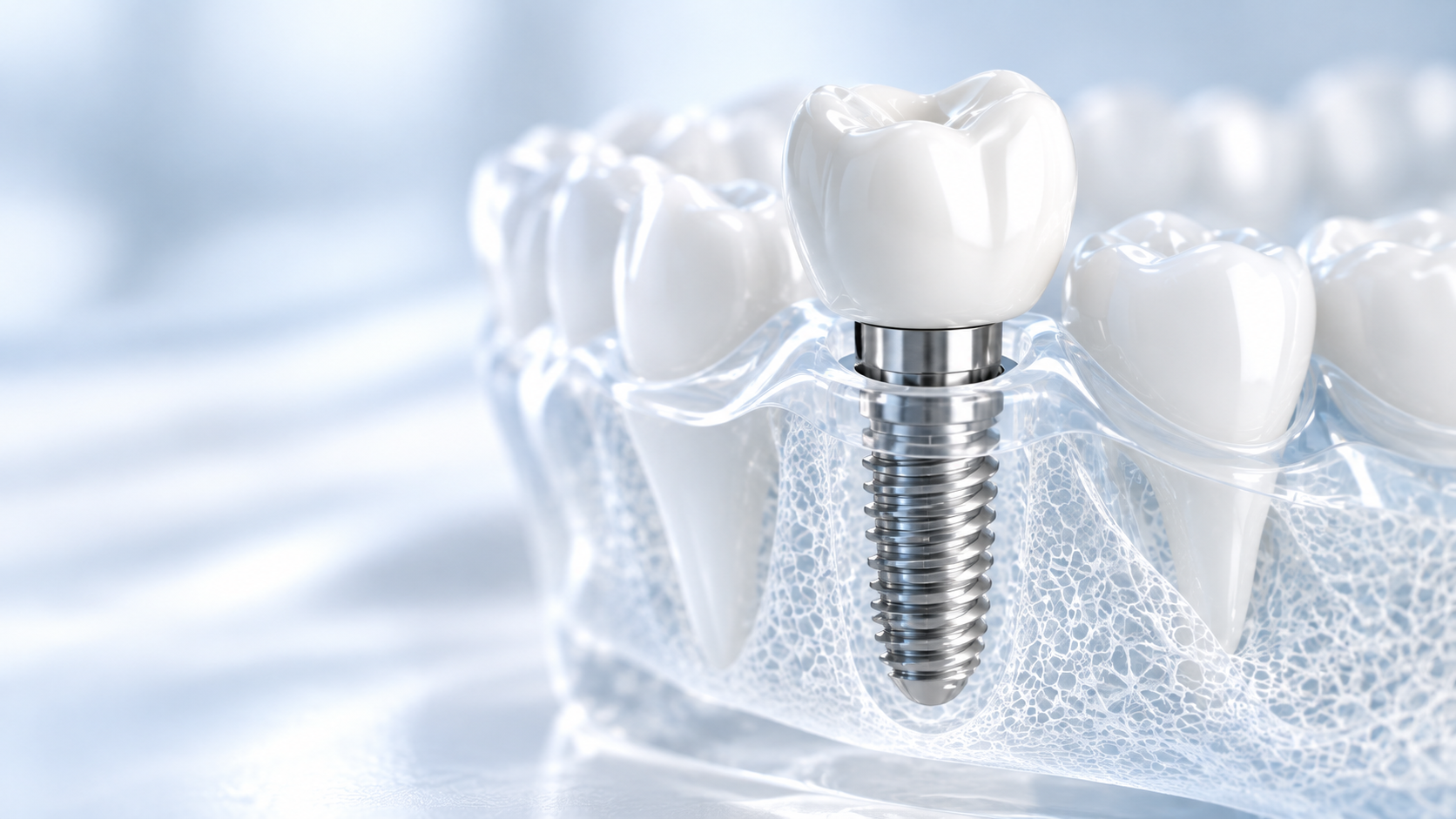 Tratamiento de implantes dentales en Clínica Dental VEN